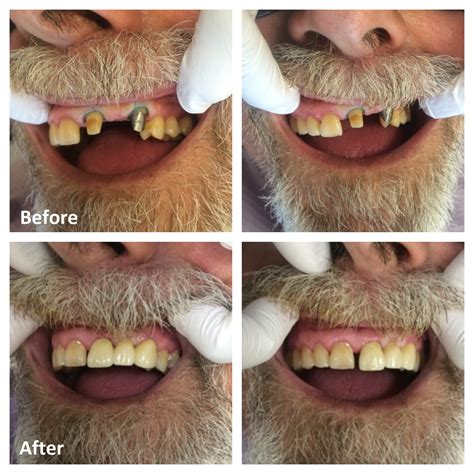 Rosebud’s Leading Dental Clinic for Crowns and Bridges.